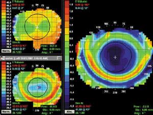 Corneal Topography And Orthokeratology Post Fit Assessment Contact