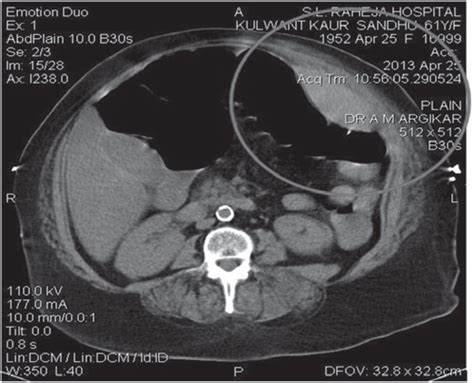 Ct Abdomen Showing Rectus Sheath Hematoma In Anterior Abdominal Wall