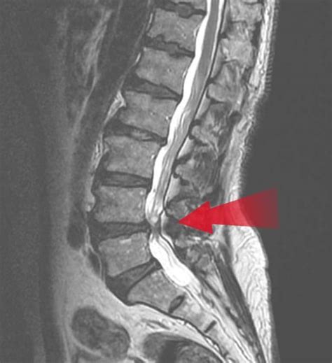 Décompression Foraminale Chirurgie rachidienne