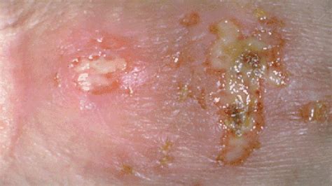 Hsv 2 Pictures On Buttocks Genital Pimples Vs Herpes The 1 Source For