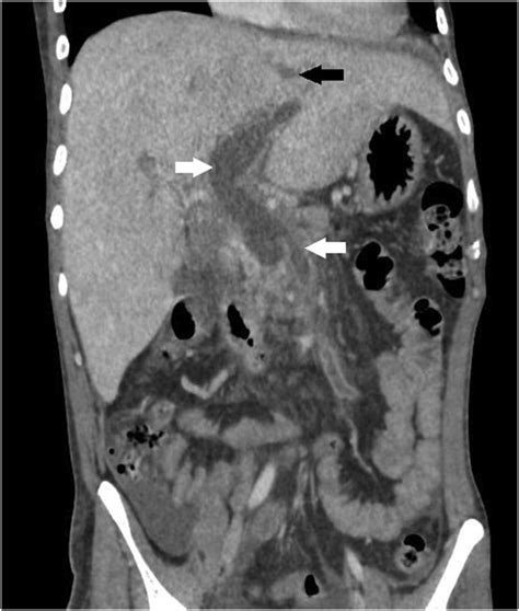 Suppurative Pylephlebitis With Portal Vein Abscess Mimicking Portal