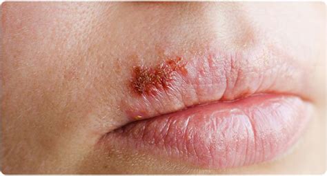 Herpes Labial Factos e Estatísticas Saiba mais