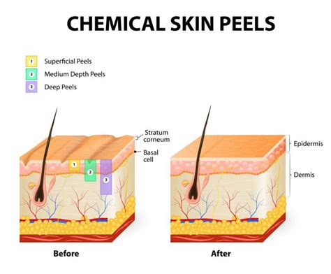 Jessner Skin Peel Explained Integrity Paramedical Skin Practitioners