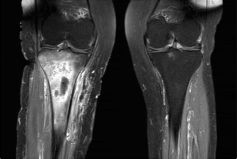 Magnetic Resonance Imaging Mri Showing The Osteomyelitis Of The Tibia