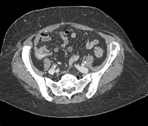 Metastatic Pancreatic Cancer To The Liver And The Left Iliac Bone 27e