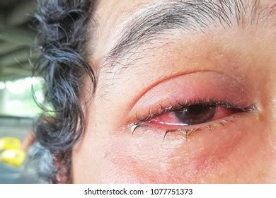 Conjunctivitis Pink Eye Symptoms Stock Photo Shutterstock