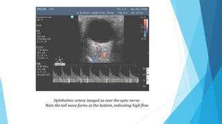 Ocular Blood Flow In Glaucoma PPT