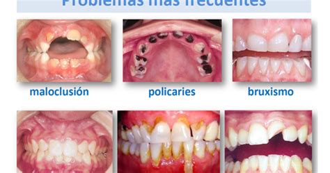 APRENDIENDO LA ODONTOLOGÍA 5 enfermedades bucales más comunes