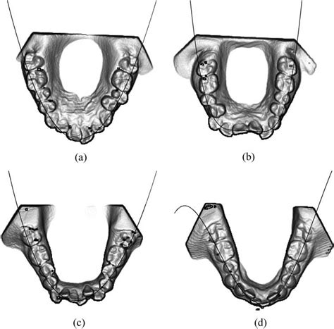 Various Forms Of Dental Arches A Malaligned Upper Teeth With