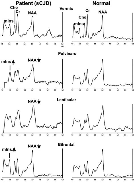 Combined Diffusion Imaging and MR Spectroscopy in the Diagnosis of
