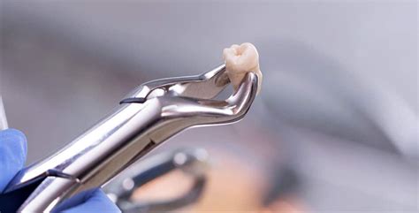 How To Prepare For A Tooth Extraction Dentist Brisbane