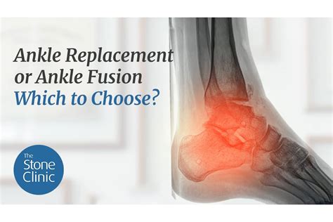 Ankle Replacement or Ankle Fusion. Which to Choose? (Video Blog)