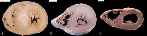 Primary Cardiomyopathies A Asymmetric Septal Hypertrophic