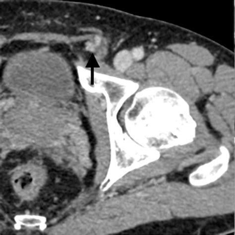 (A,B) Subsequently, a contrast-enhanced computed tomography (CT)... | Download Scientific Diagram