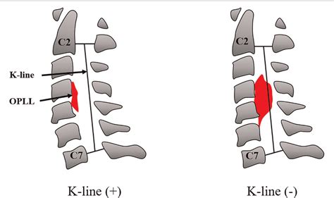 Figure 1 From The Effect Of K Line Classification In Different Cervical