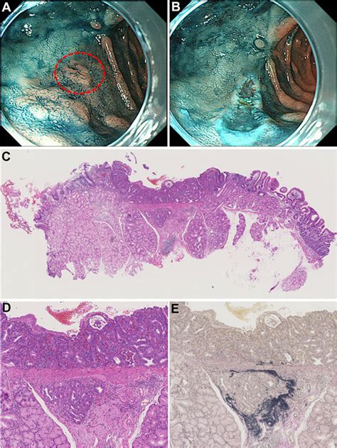 Esophagogastroduodenoscopy Revealing A A Flat Lesion In The First Part Download Scientific