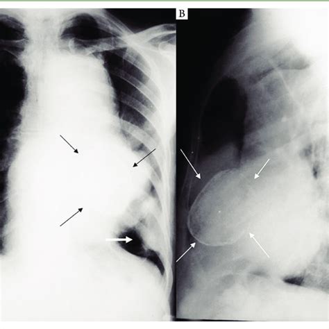 A Chest Radiograph In Pa Projection Shows A Large Mediastinal Mass Download Scientific Diagram