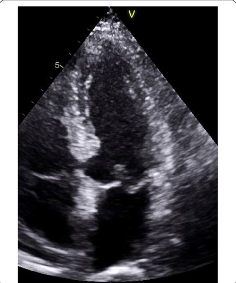 Case Figure Transthoracic Echocardiogram Tte Four Chamber At