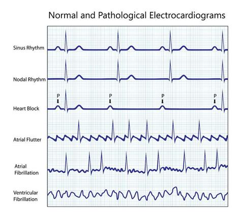 Atrial Flutter - Cardiology - Highland Hospital - University of ...