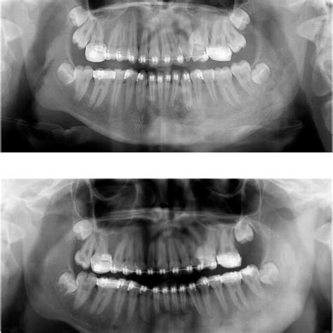 Pre And Post Treatment Panoramic Radiography Of A Year Old Patient