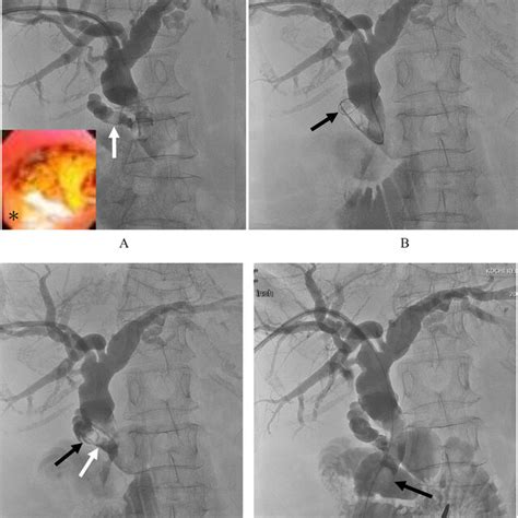 A Cholangiogram Shows Cystic Duct Stone White Arrow A