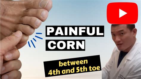 treat painful corns  toes  bridget mireles blog