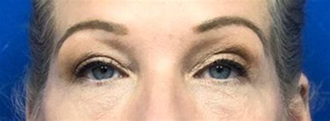 Blepharoplasty Philadelphia Eyelid Surgery In Philadelphia StarkMD