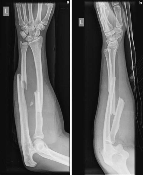 A B Preoperative Anteroposterior And Lateral Radiograp Open I