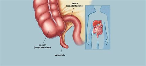 Laparoscopic Surgery for Appendicitis - Neoalta Speciality Clinic