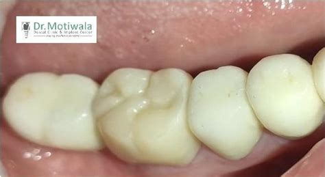 Monolithic Zirconia Is Best For Posterior Teeth Natural Teeth