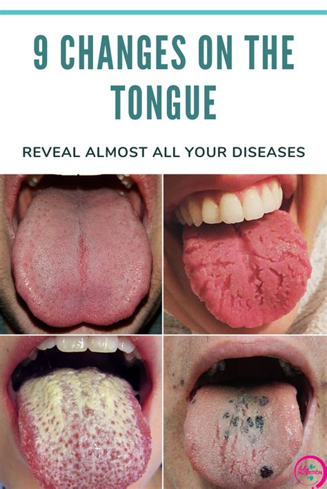 cracked tongue  symptoms pictures painful   vrogueco