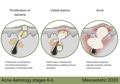 Acne Treatments Oasis Wellbeing Clinic