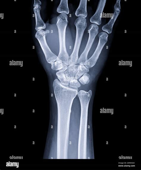 Das Röntgenbild des Handgelenkes zur Diagnose der rheumatoiden