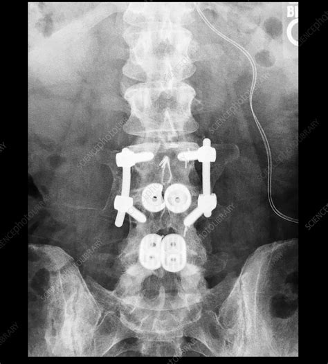 Lumbar Spinal Instrumentation X Ray Stock Image C