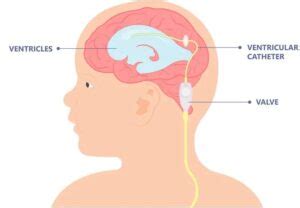 Ventriculoperitoneal Vp Shunt Surgery In India