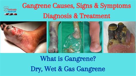 What Is Gangrene Signs Symptoms Diagnosis Treatment Dry Wet