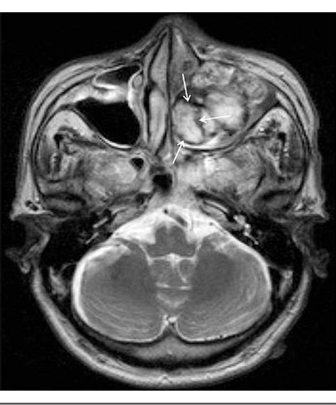 Figure From Hemangioma Of The Maxillary Sinus Presenting As A Mass