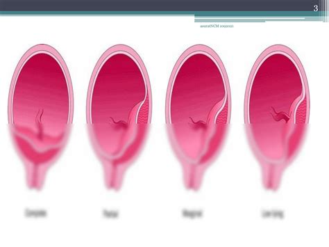 SOLUTION Placenta Previa Copy Studypool