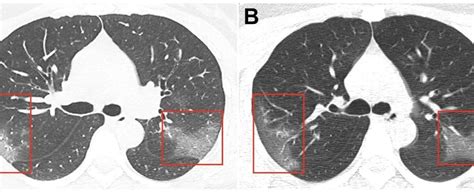 After defeating the coronavirus, some patients suffer lung damage