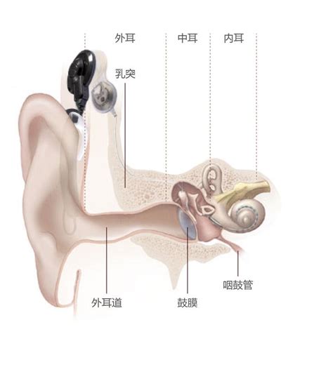 内耳发育畸形的患者能植入人工耳蜗吗？ 知乎