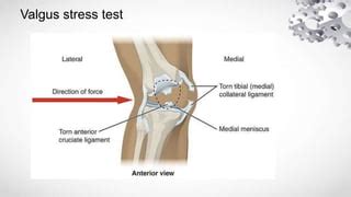 Internal Derangements Of Knee Pptx In Orthopaedics PPT