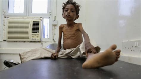 Yemen Could Face Famine If No Action Taken Un Ctv News