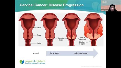 What The Health Lets Talk About Personalized Cervical Cancer