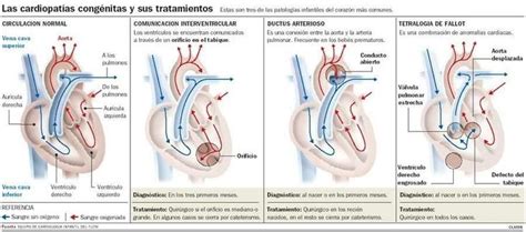 Clasificación De Cardiopatías Congénitas