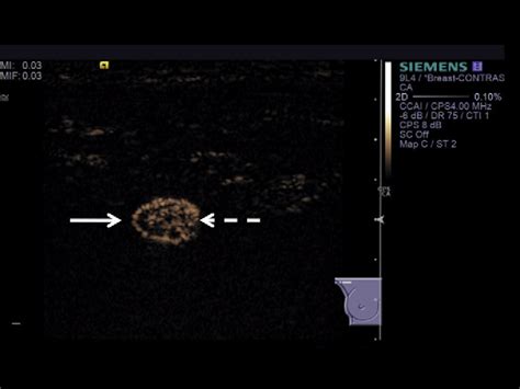 Figure From Microbubble Detection And Ultrasound Guided Vacuum