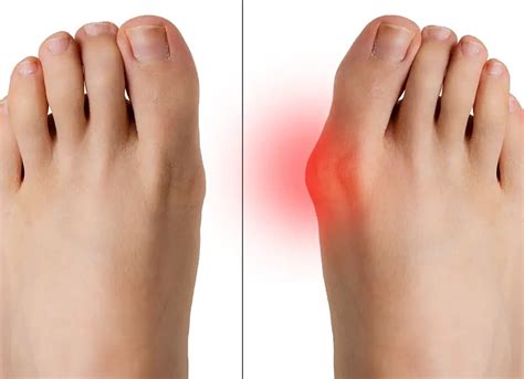 Bursite des Pieds Symptômes Causes et Stratégies de Soulagement