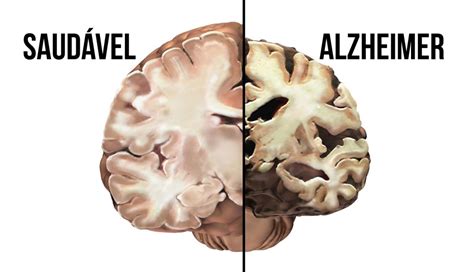 Alzheimer Cerebro Antes E Depois Comparacao Biocase