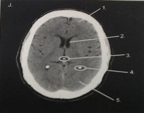 CT Head Anatomy J Quiz