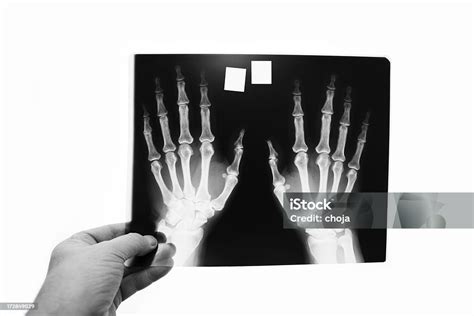 Xray Image Of Human Wrist Stock Photo - Download Image Now - Arthritis ...