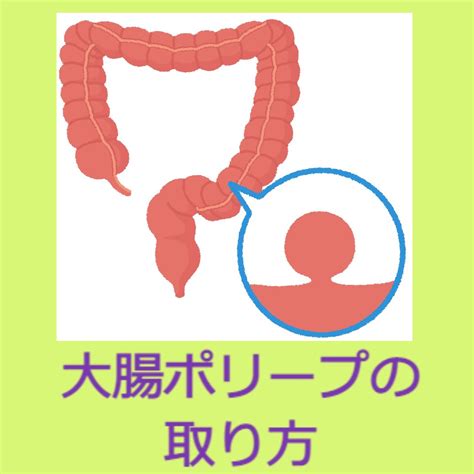 大腸ポリープの切除方法｜医療法人 好友会 ひらたクリニック｜古市駅、羽曳野市の消化器内科・内視鏡内科・内科